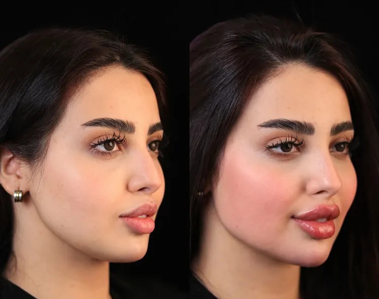 ماندگارترین روش چاقی صورت