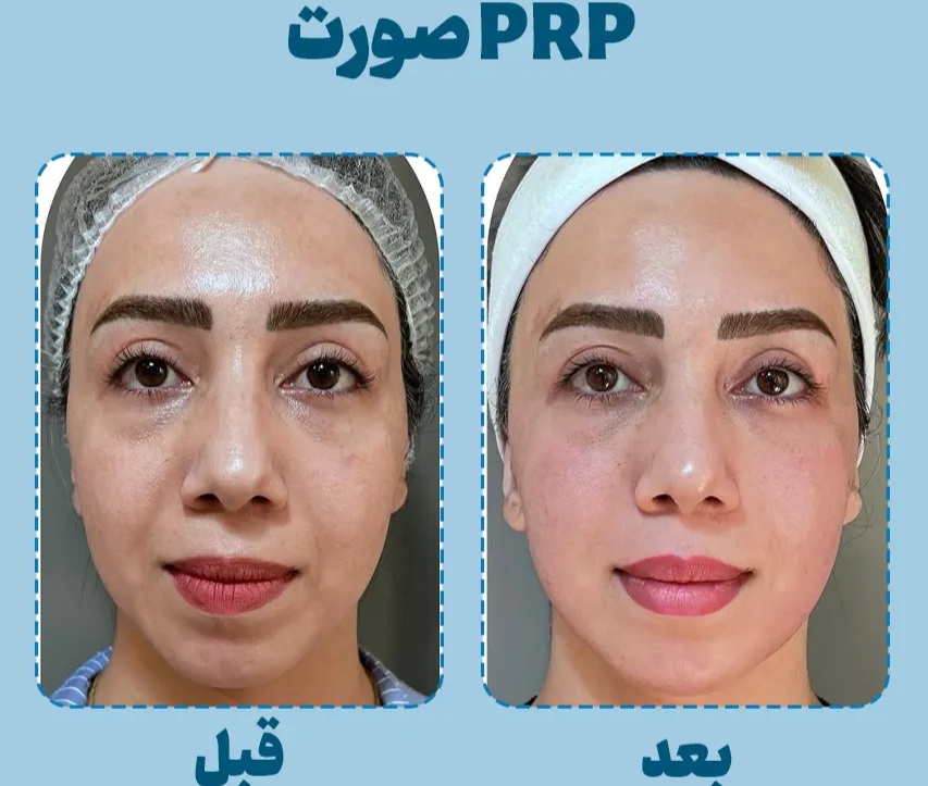 ماندگارترین روش چاقی صورت